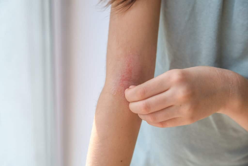 Quelle pierre pour soigner l'eczéma ? 10 cristaux efficaces 1 eczema sur bras